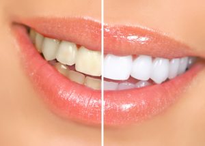 Woman’s teeth before and after teeth whitening